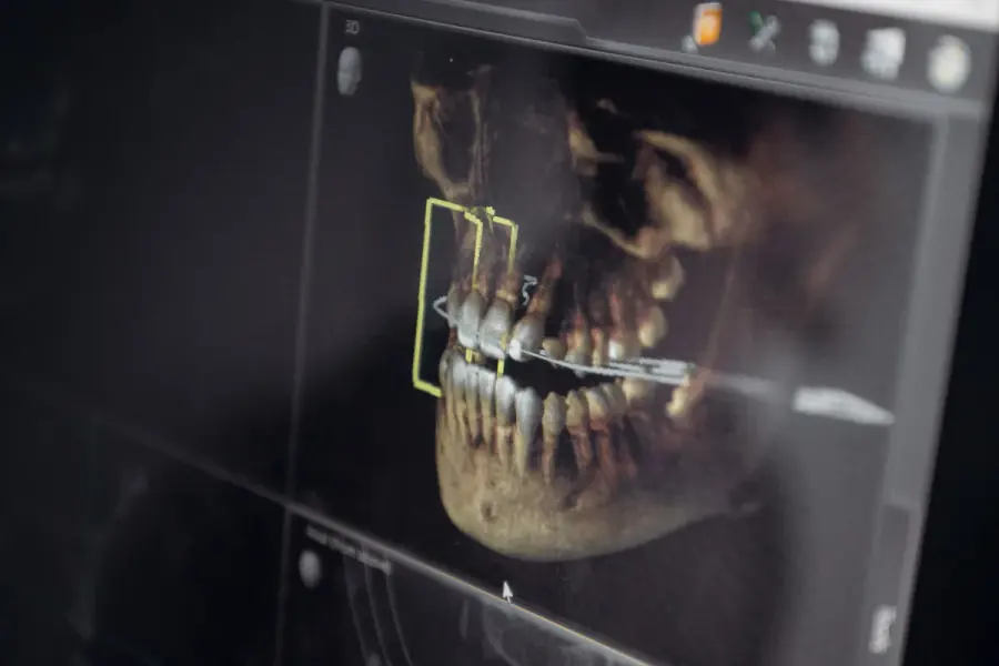3D CBCT scan used to plan dental implant treatment