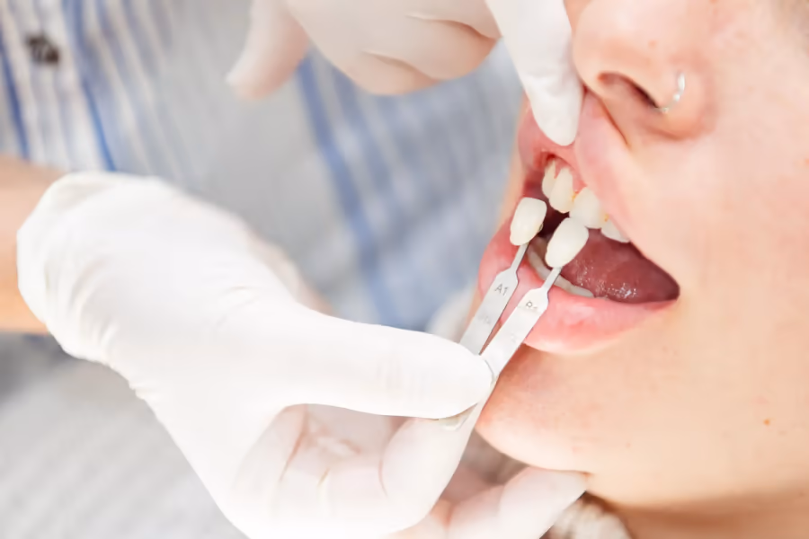 Shade matching for a dental restoration